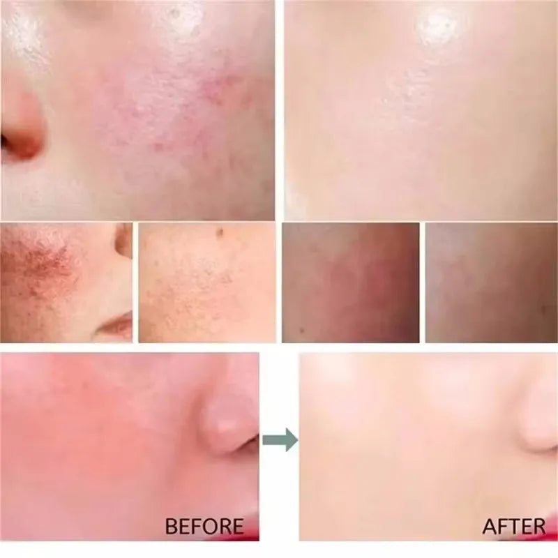 Facial Redness Repair Serum Improve Sensitive Skin Dryness Moisturizer Hydrating Sooth Lotion Removal Rosacea Korean Cosmetics