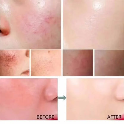 Facial Redness Repair Serum Improve Sensitive Skin Dryness Moisturizer Hydrating Sooth Lotion Removal Rosacea Korean Cosmetics