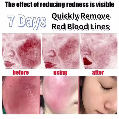 Facial Redness Repair Serum Improve Sensitive Skin Dryness Moisturizer Hydrating Sooth Lotion Removal Rosacea Korean Cosmetics